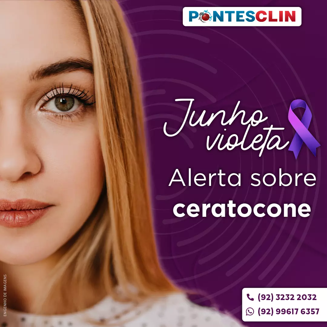 Junho violeta alerta sobre ceratocone
